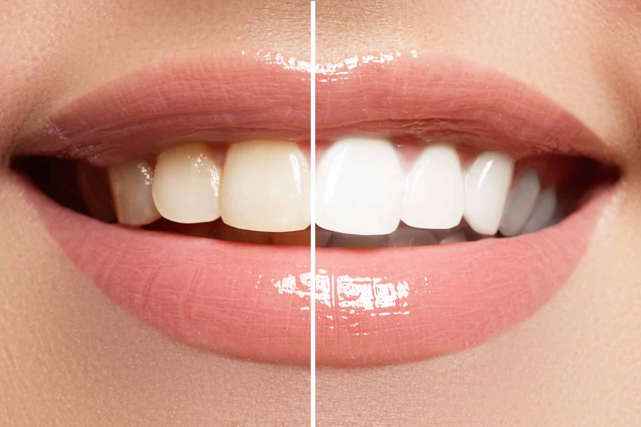 Vorher-Nachher-Aufnahme einer Zahnaufhellung: links Mund mit dunkleren Zähnen, rechts strahlend weiße Zähne.