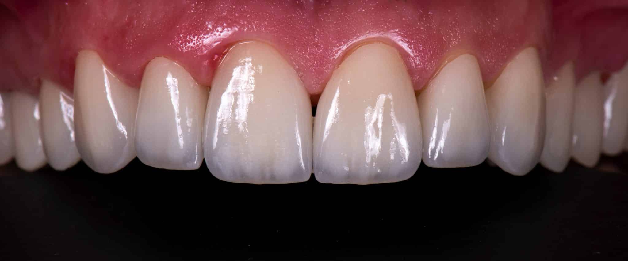 Helle, obere Zahnreihe mit Veneers und Keramikkronen.