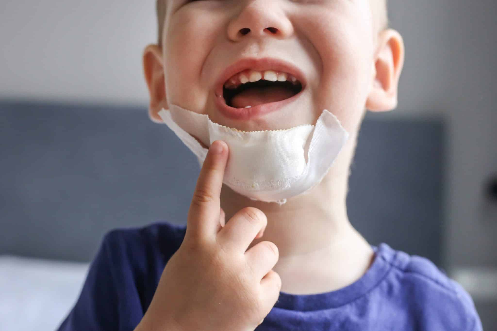 Ein weinendes Kind mit Zahnverletzung, verbundenem Kinn und Schmerzen, zeigt mit dem Finger an das verletzte Kinn.