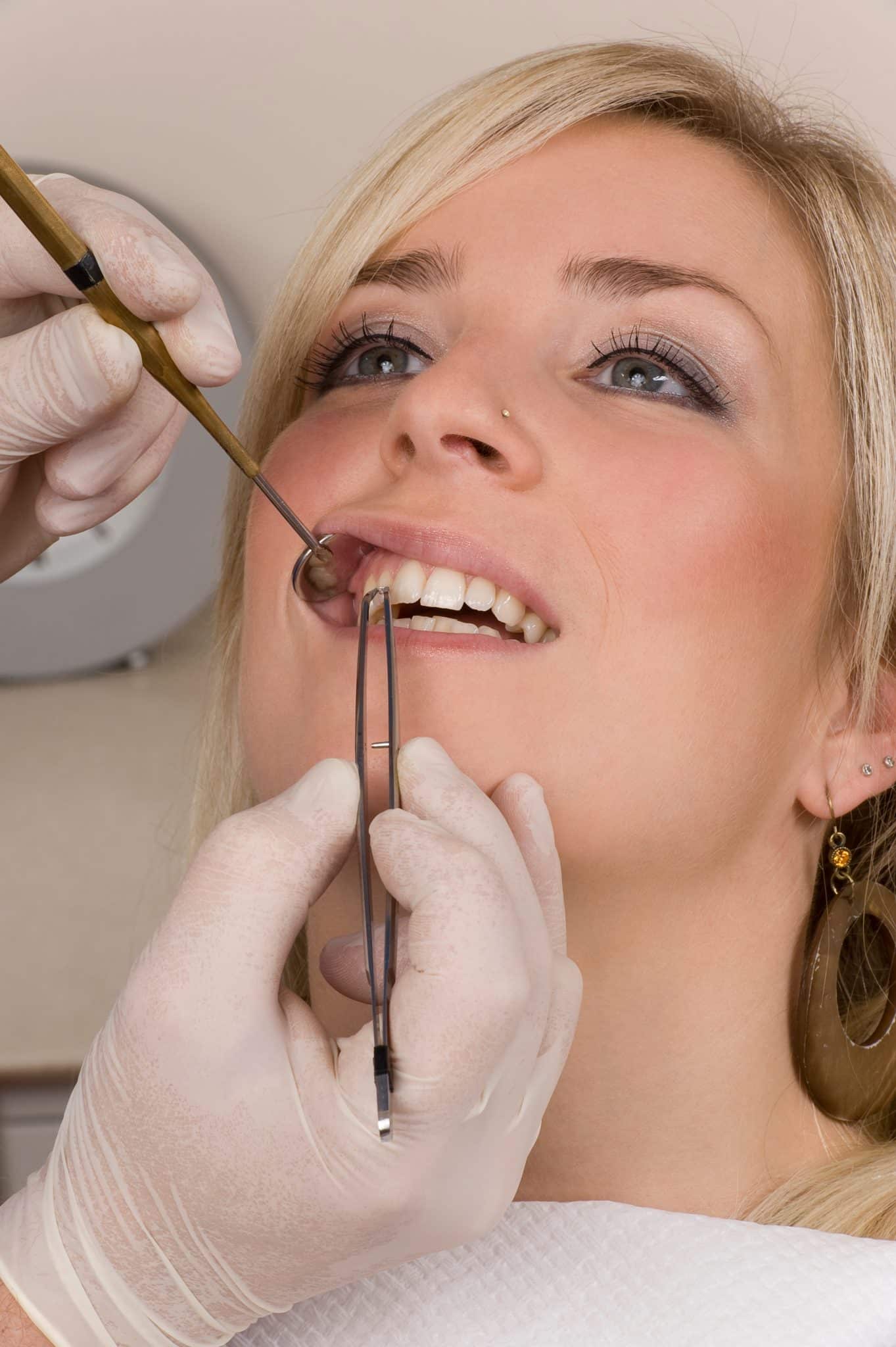 Ein Zahnarzt entfernt bei einer jungen, blonden Frau den Zahnschmuck von einem Zahn.