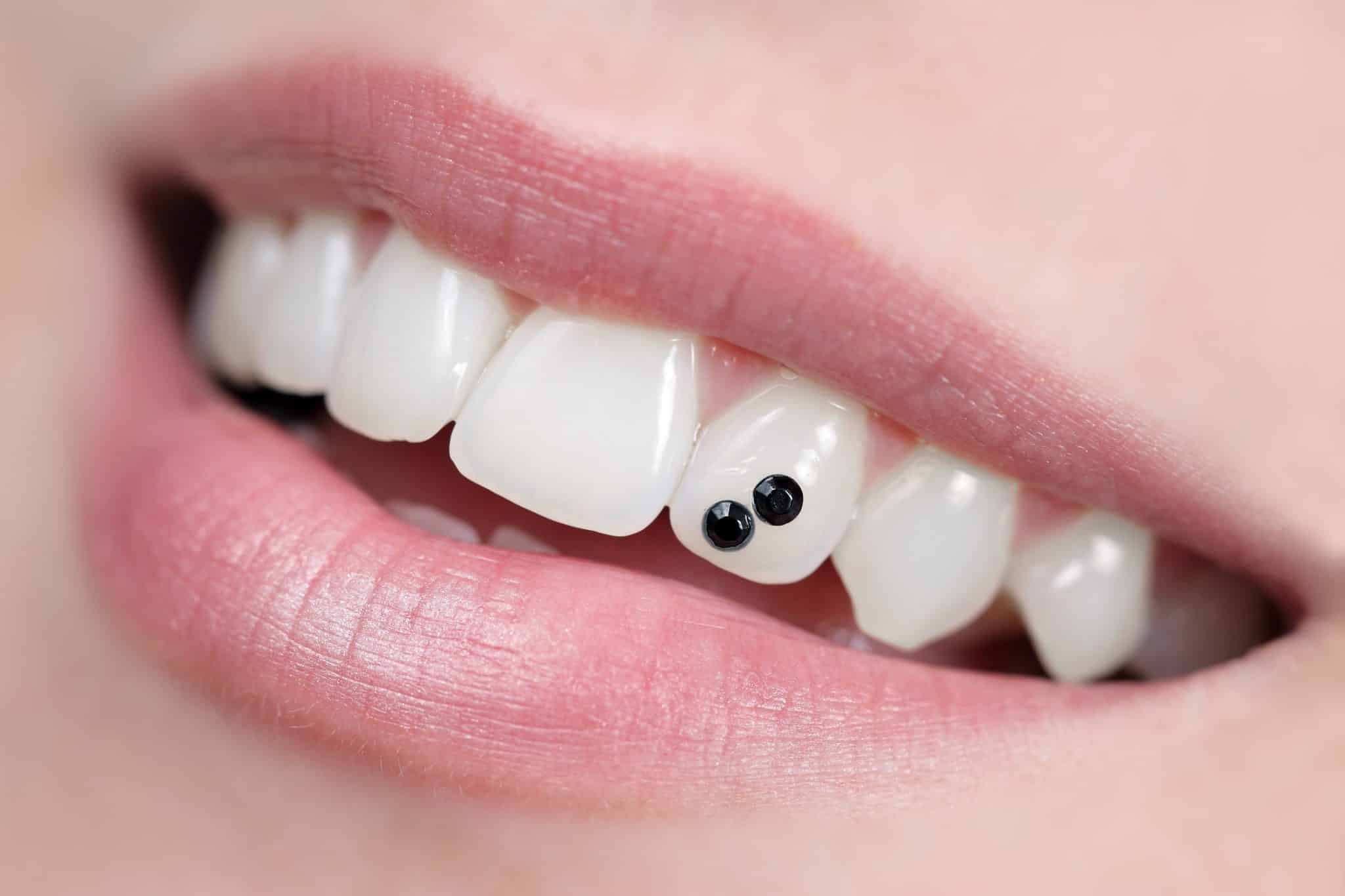 Das Foto zeigt den geöffneten Mund einer jungen Frau und ihre Zähne mit Zahnschmuck.