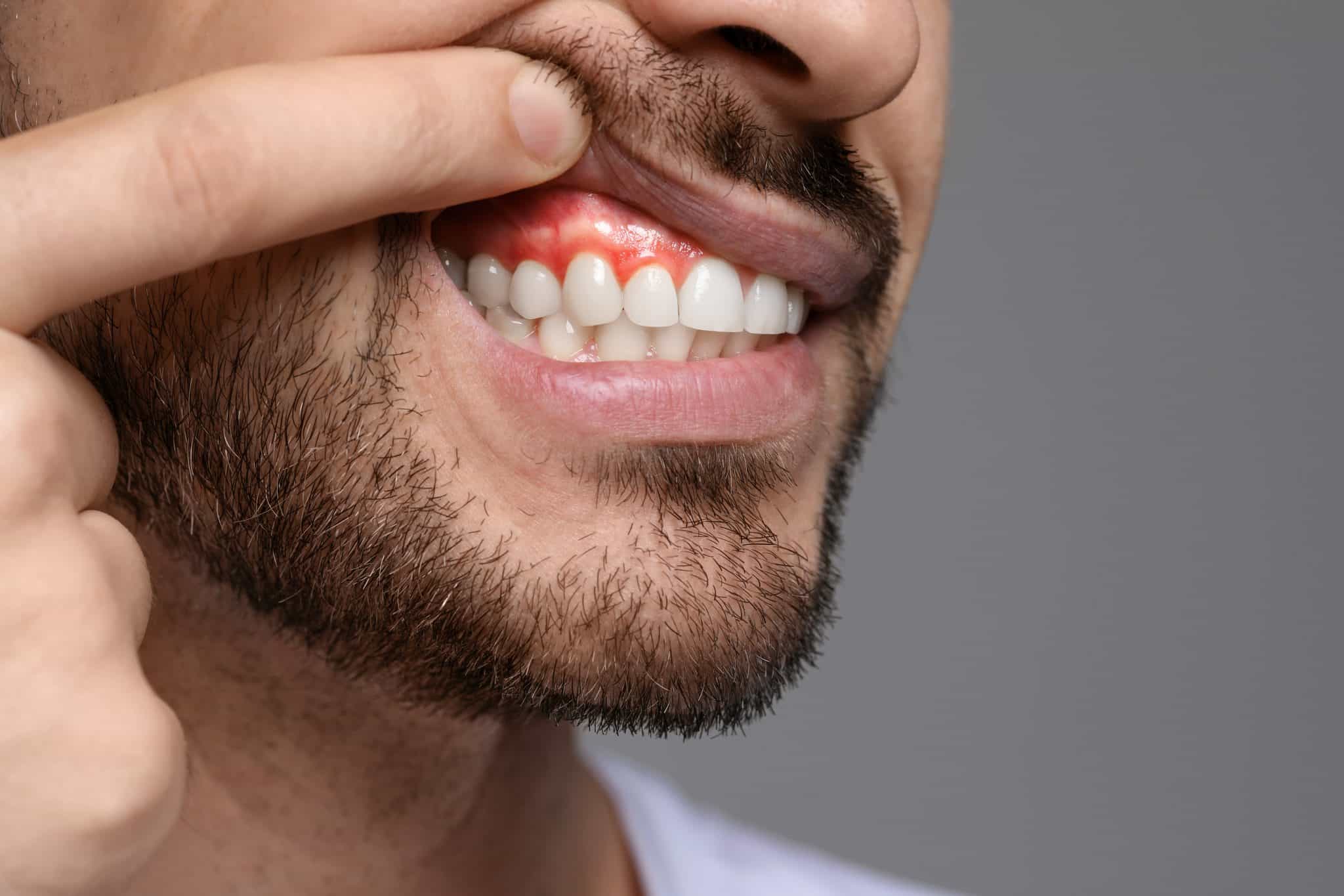 Das Foto zeigt einen jungen Mann mit 3-Tage Bart der seine Zahnfleischentzündung zeigt.