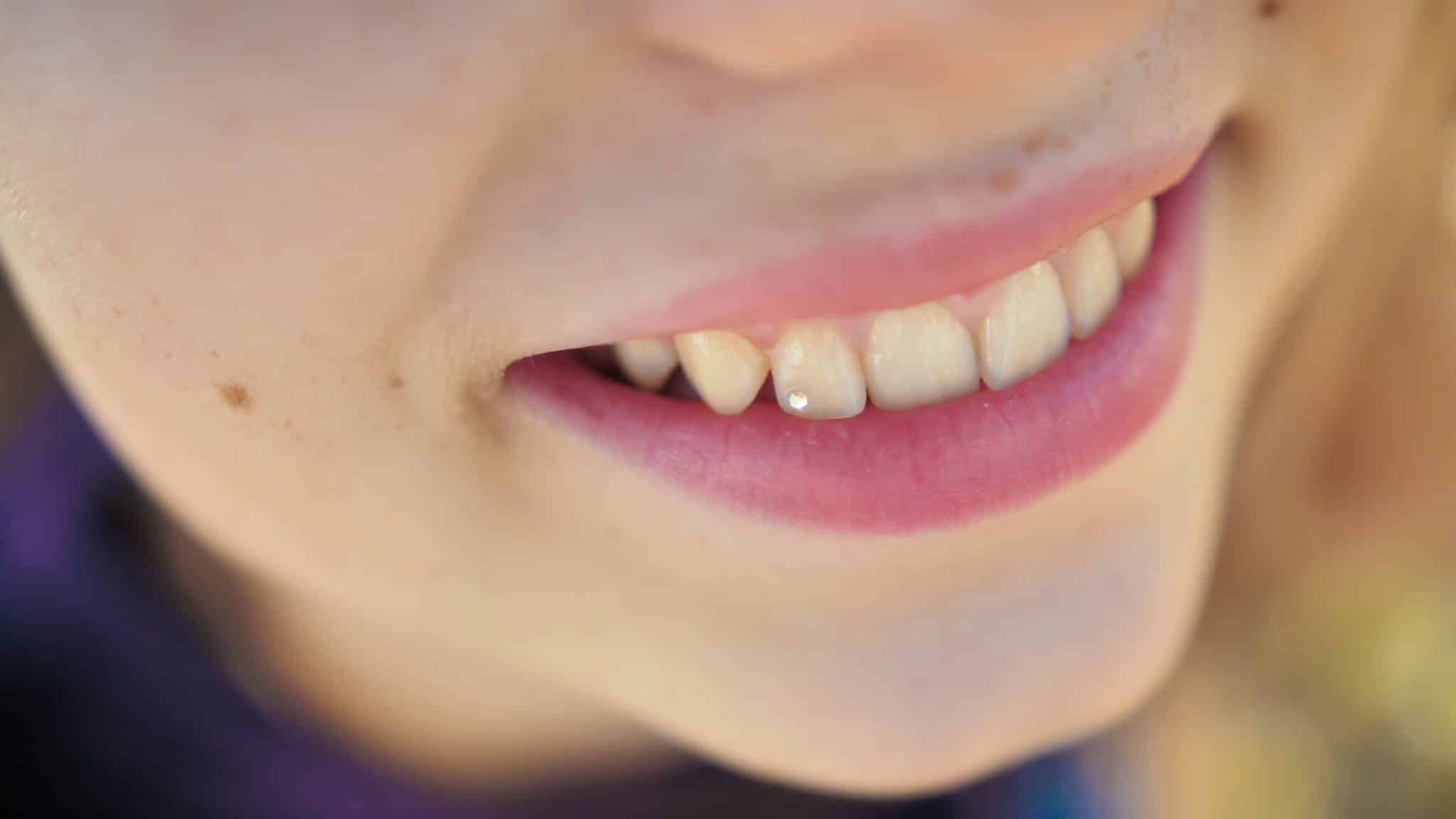 Das Foto zeigt eine lächelnde junge Frau mit einem Diamant als Zahnschmuck.