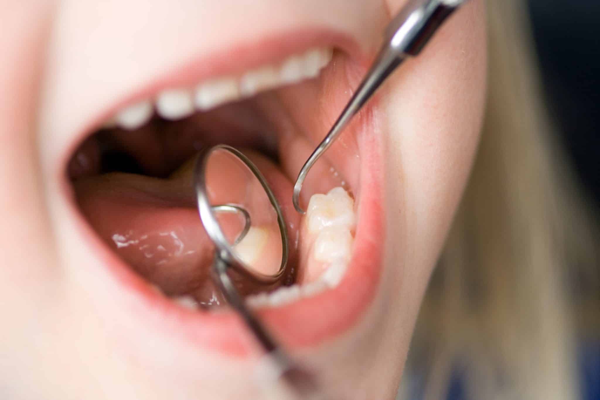 Das Foto zeigt einen offenen Kindermund bei der Zahnprophylaxe.