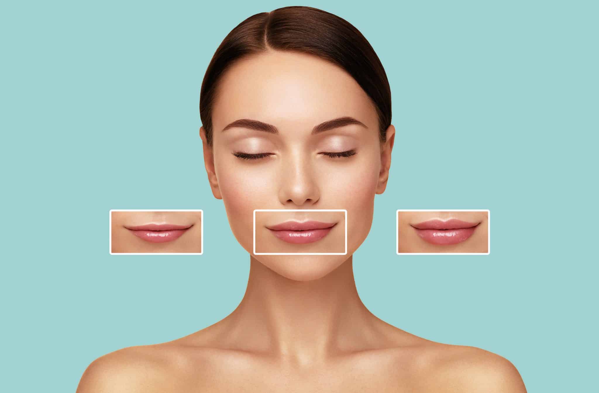 Das Foto zeigt eine Lippenkorrektur mit Hyaluron vor und nach der Schönheitsbehandlung.